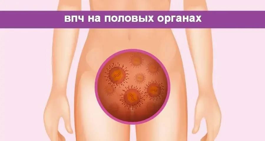 Аногенитальные (венерические) бородавки — это не только эстетическая проблема